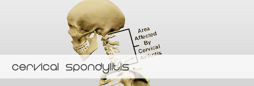 6 Best Homeopathic Medicines for Cervical spondylitis and Neck Pain.